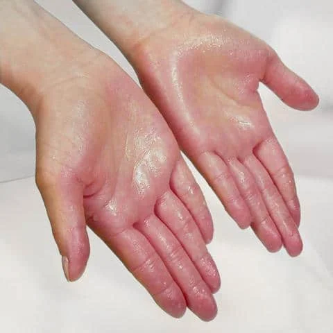 Close-up of sweaty hands showing hyperhidrosis symptoms