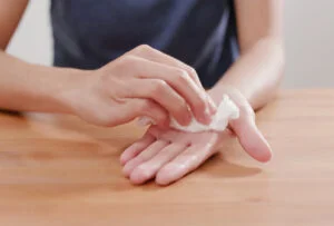 Sweaty palms treatment for palmar hyperhidrosis